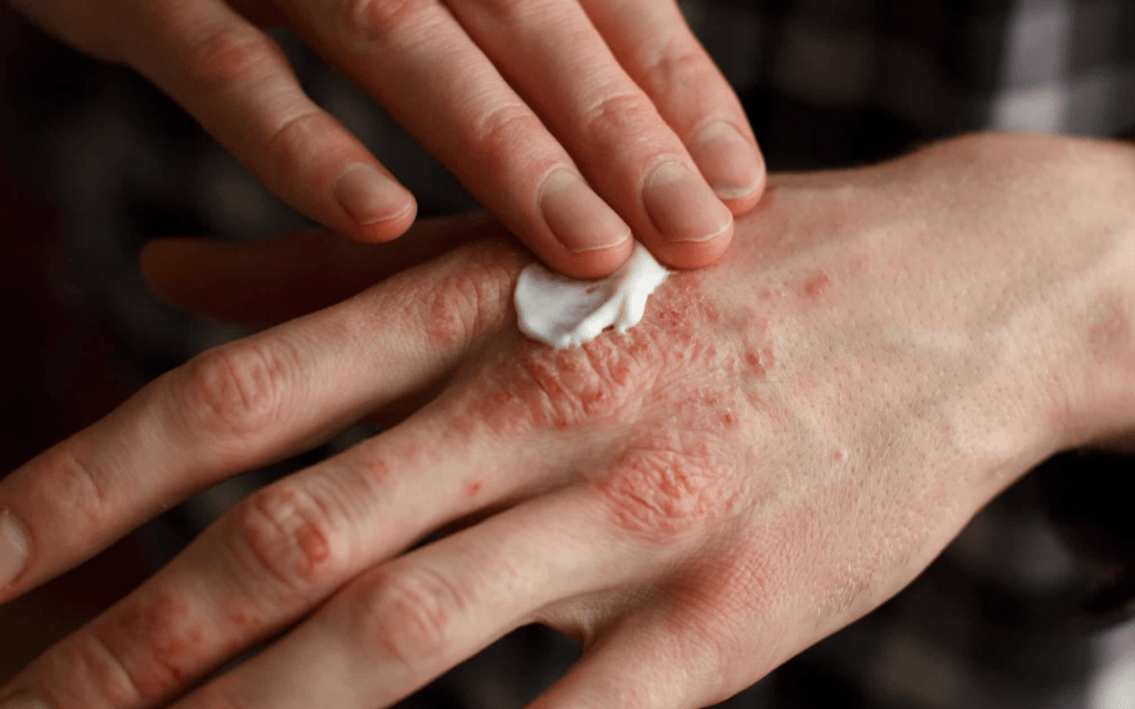 Día Mundial de la Psoriasis: la intervención temprana como clave para cambiar el curso de la&nbsp;enfermedad